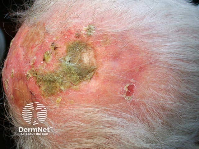 A thick crust overlying a large erosion on a bald scalp in erosive pustular dermatosis