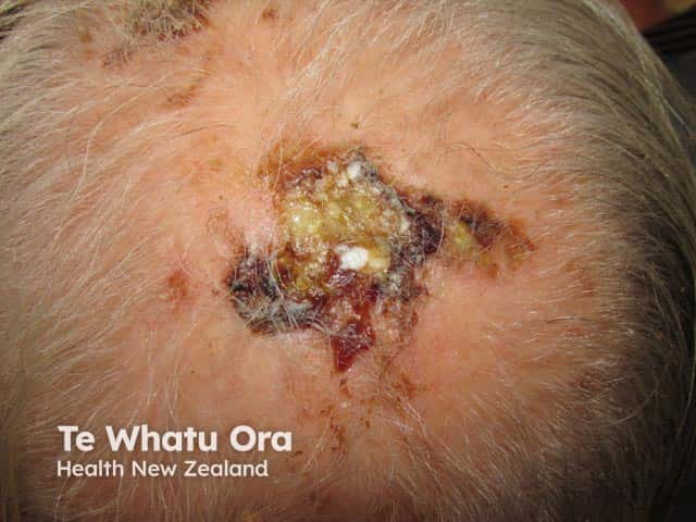 Co-existing scalp squamous cell carcinoma and erosive pustular dermatosis in a sun damaged bald scalp