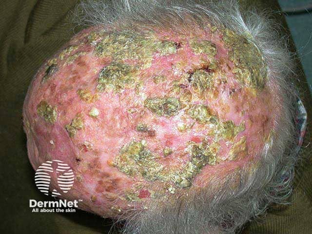 Multiple thick crusts overlying large erosions on a bald scalp in erosive pustular dermatosis