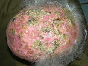 Erosive pustular dermatosis of the scalp
