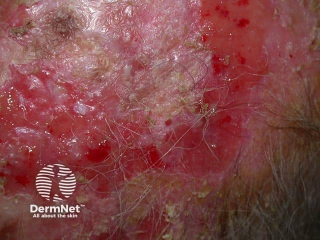 A large erosion revealed after removing the overlying crust in erosive pustular dermatosis