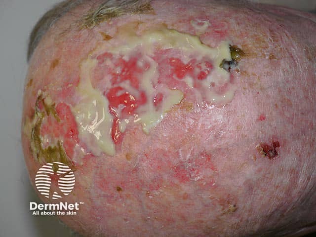 Removal of crusts reveals lakes of pus and erosions in erosive pustular dermatosis