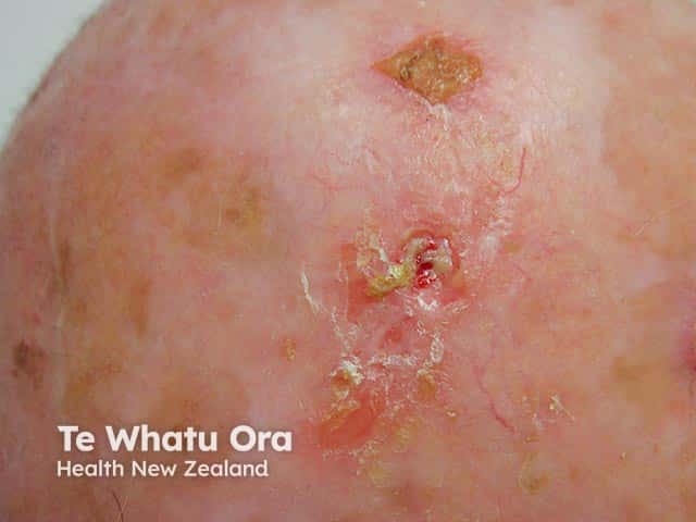 Erythema and crusting in a sun-damaged scalp due to erosive pustular dermatosis