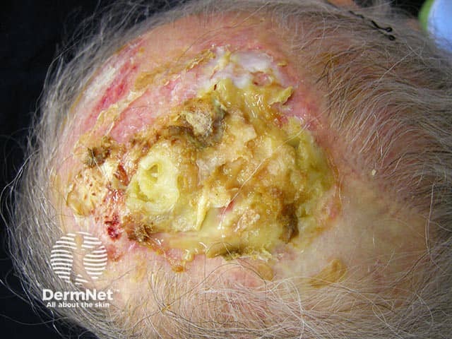 Huge crusts overlying eroded areas on a bald scalp in erosive pustular dermatosis