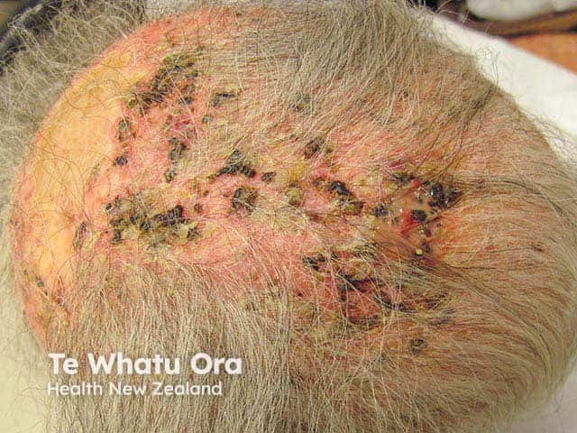 Multiple crusts in a balding scalp overlying erosive pustular dermatosis