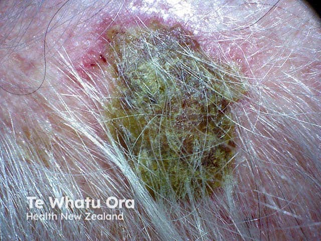 A large crust in a balding scalp overlying erosive pustular dermatosis