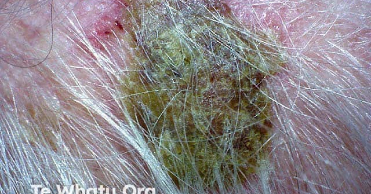 Erosive pustular dermatosis of the scalp image