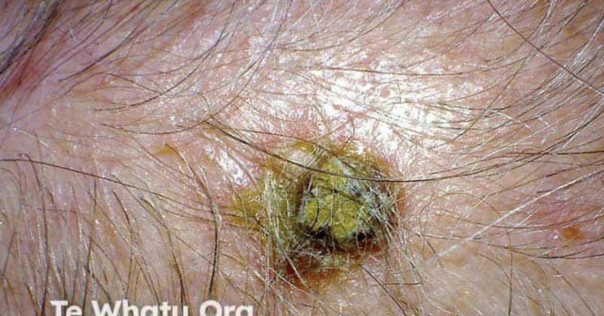 Erosive pustular dermatosis of the scalp image