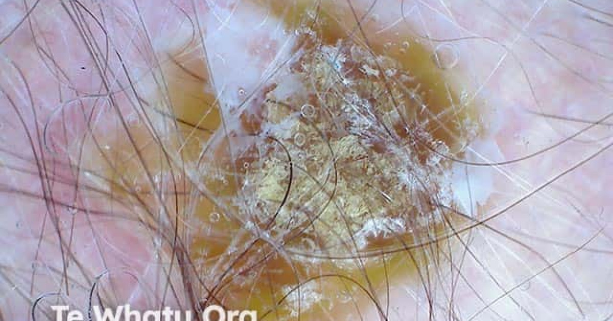 Erosive pustular dermatosis of the scalp image