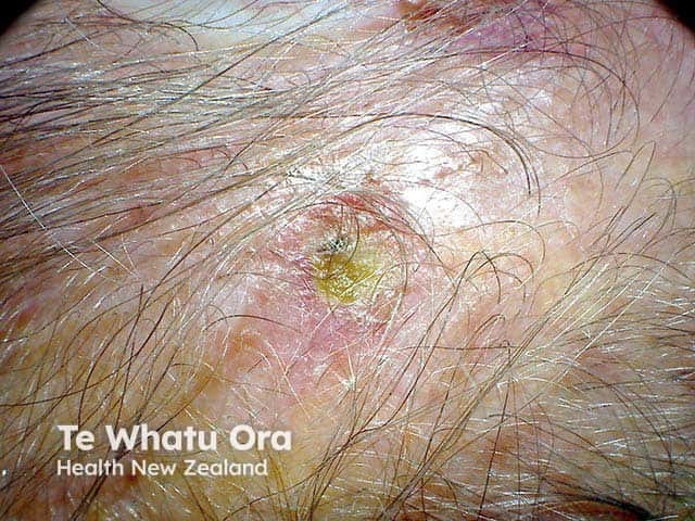 Erythema and crusting on a sun-damaged scalp due to erosive pustular dermatosis