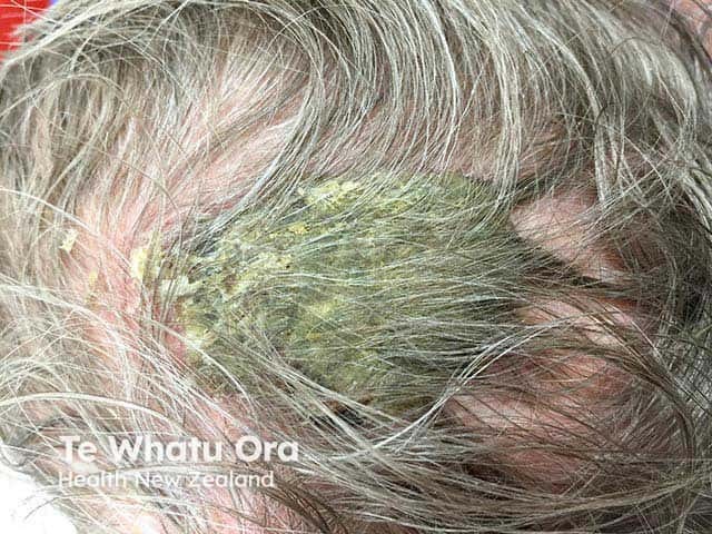 A large adherent crust overlying an area of erosive pustular dermatosis of the scalp