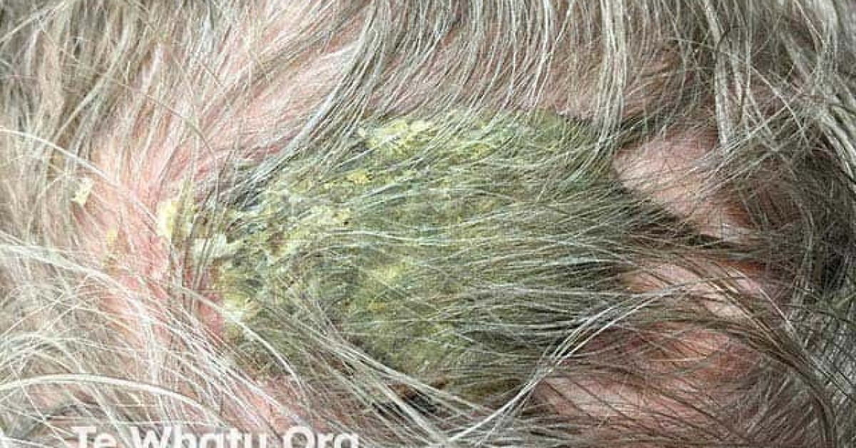 Erosive pustular dermatosis of the scalp image