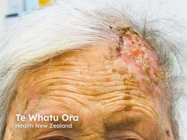 Erosive pustular dermatosis of the scalp in a woman with scarring alopecia