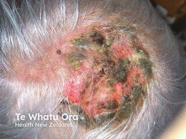 Multiple crusts in a balding scalp overlying erosive pustular dermatosis