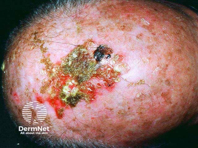 Multiple crusts in a balding scalp overlying erosive pustular dermatosis