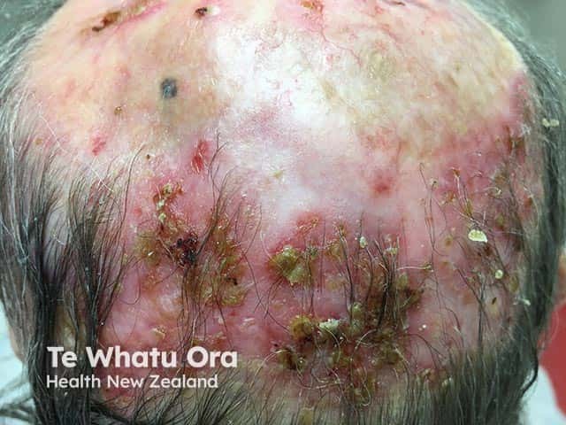 Severe actinic damage with areas of erosive pustular dermatosis and hair loss