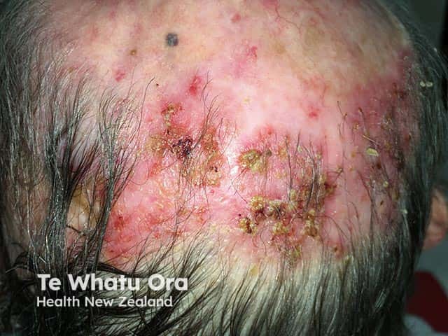 Multiple crusts in a balding scalp overlying erosive pustular dermatosis