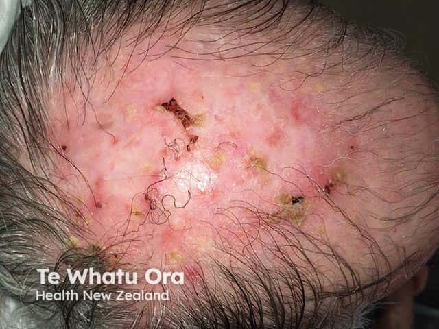 Severe actinic damage with areas of erosive pustular dermatosis and hair loss