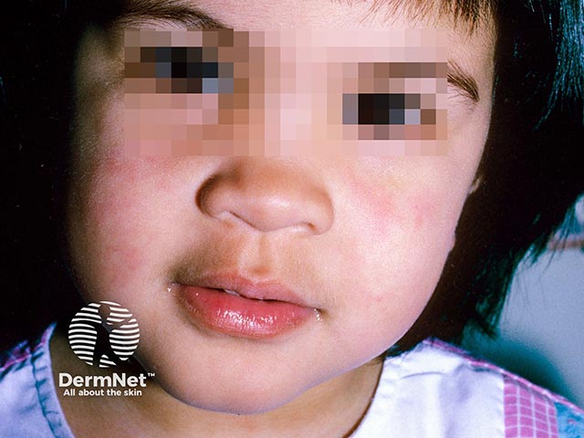 'Slapped cheeks' erythema due to erythema infectiosum