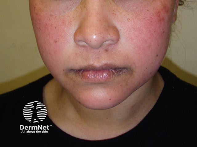 Acute cheek erythema in erythema infectiosum