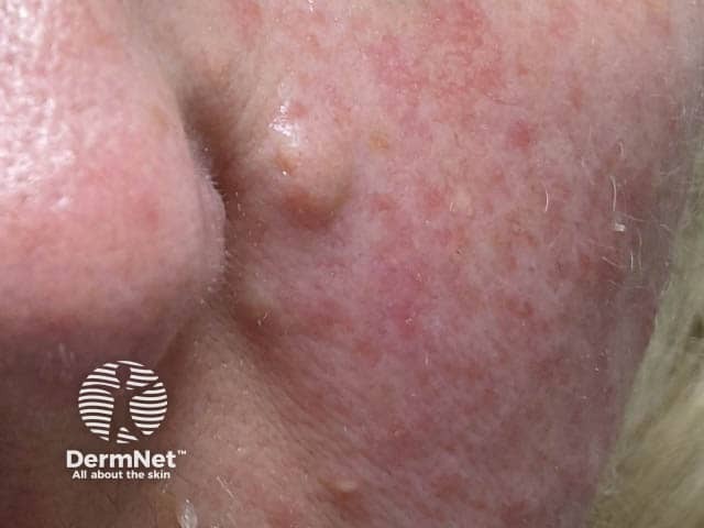 Face mask dermatitis