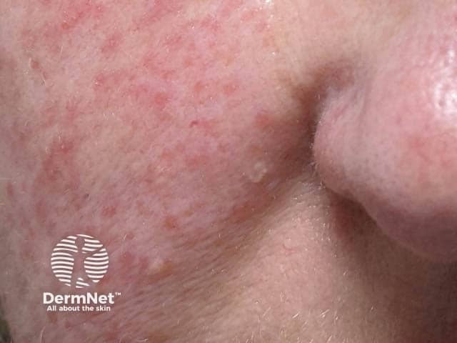 Face mask dermatitis