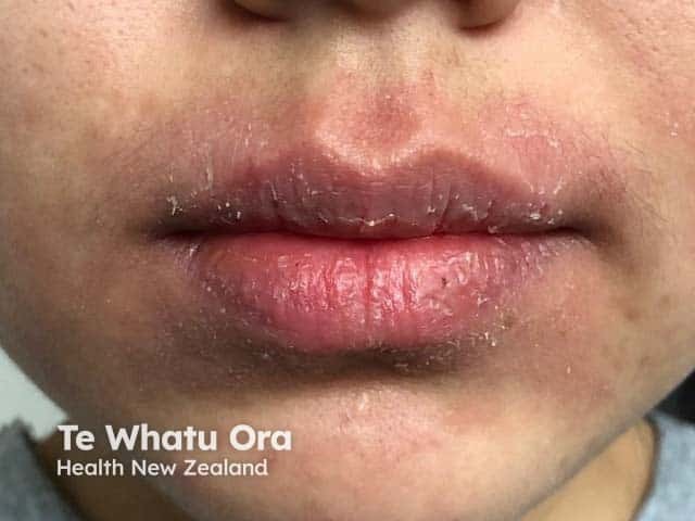Lip eczema from mask wearing