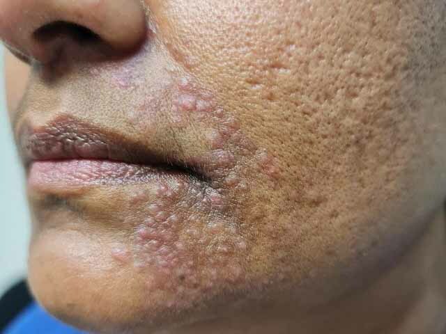 Face mask induced perioral dermatitis