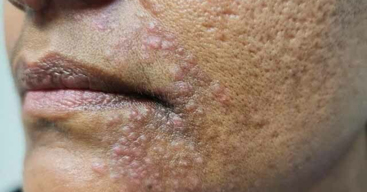 Mask Rash With Swelling Face mask dermatitis image