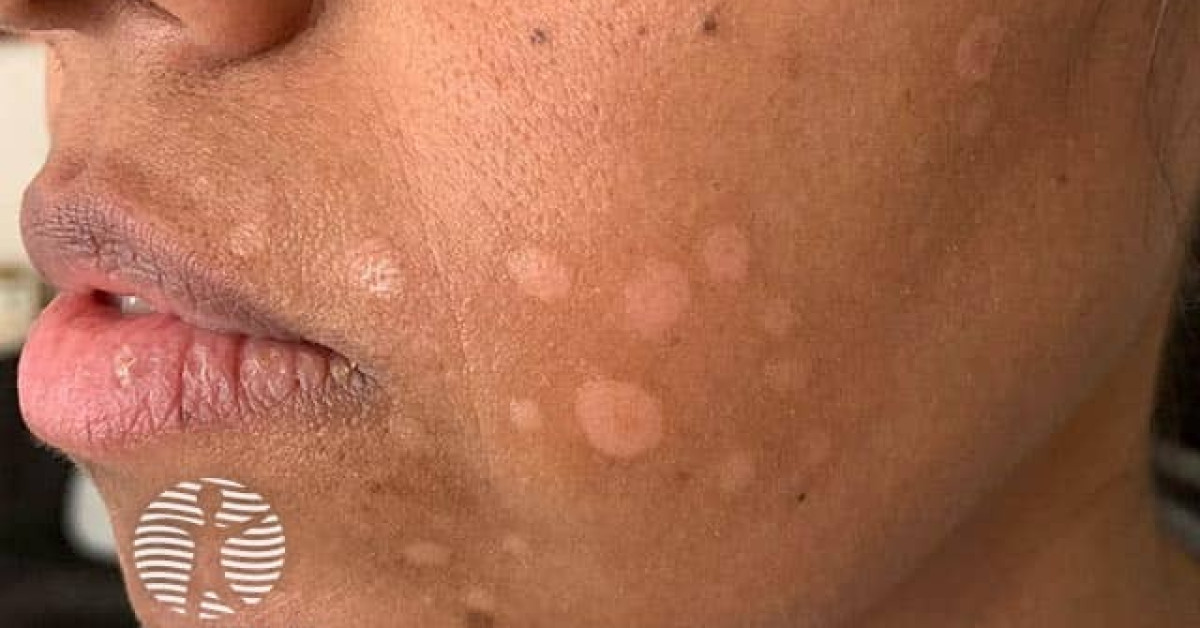 Facial discoid dermatosis image