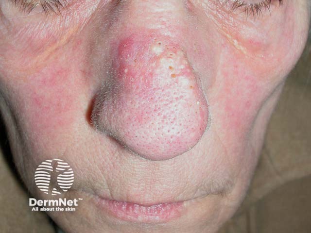 Comedones and small epidermal cysts arising on solar elastosis on the nose - Favre-Racouchot syndrome