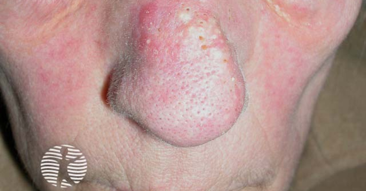 Favre Roucochot Favre-Racouchot syndrome image