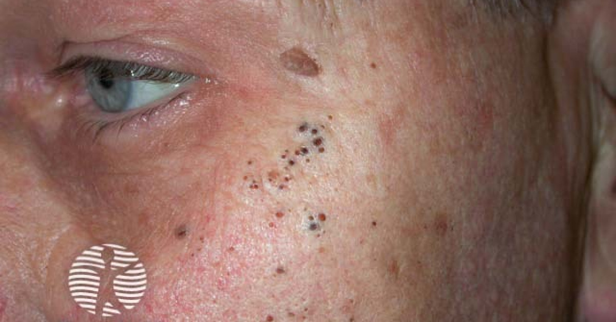 Favre-Racouchot syndrome image