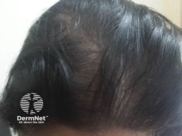 Frontal thinning and widened parting in female androgenetic alopecia