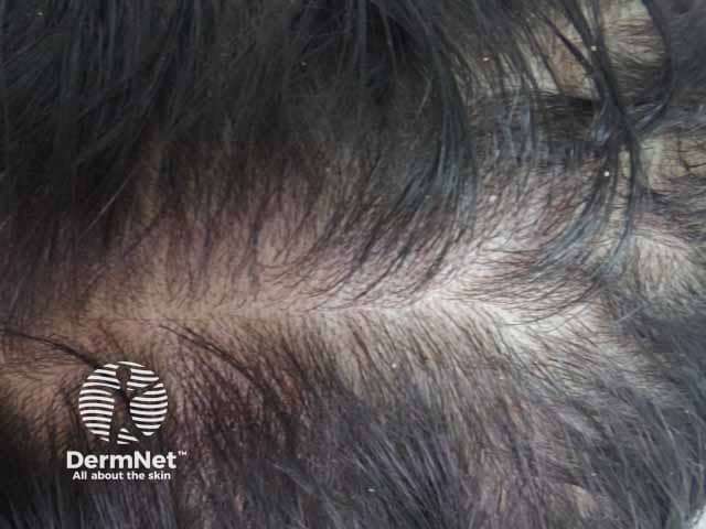 Thinning over the scalp vertex in female androgenetic alopecia