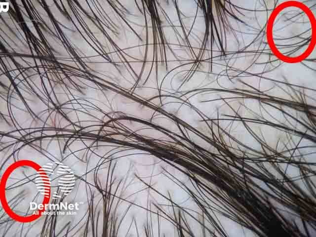 Dermoscopic image showing hair shaft diversity of more than 20% and brown peripilar pigmentation (red circles) denoting early female pattern hair loss