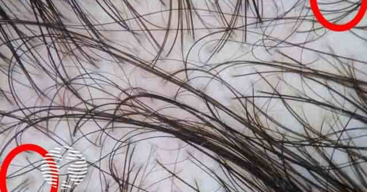 DermNet® - Female pattern hair loss image