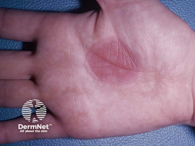 A typical oval erythematous fixed drug eruption - palms, soles, and lips are a common site. As they regress, hyperpigmentation is usual