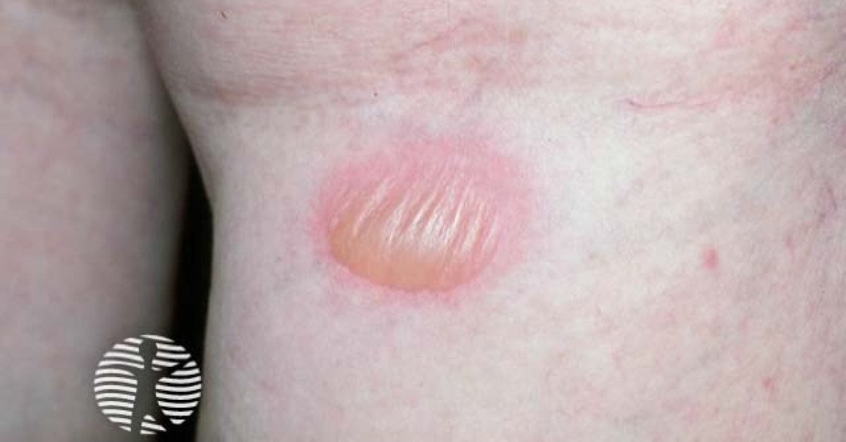 Fixed Drug Eruption Image pichler-tools-australia-cheap-buying-www-oceanproperty-co-th