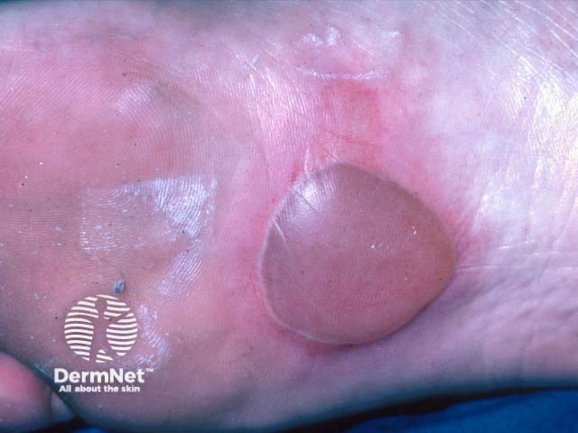 Plantar bullous fixed drug eruption due to cotrimoxazole