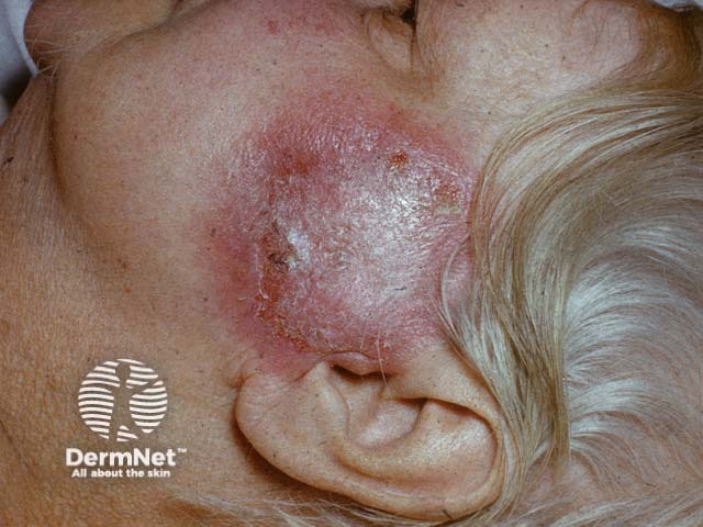 A fixed drug eruption on the cheek; it resolved to leave hyperpigmentation 