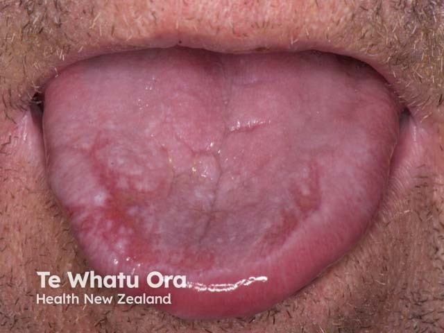 A recurrent blistering lesion on the tongue - it arose within a day of ingesting cotrimoxazole on each occasion it was taken