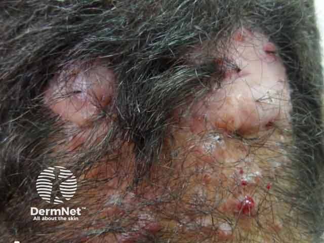 Pustules, nodules and hair tufting in folliculitis decalvans