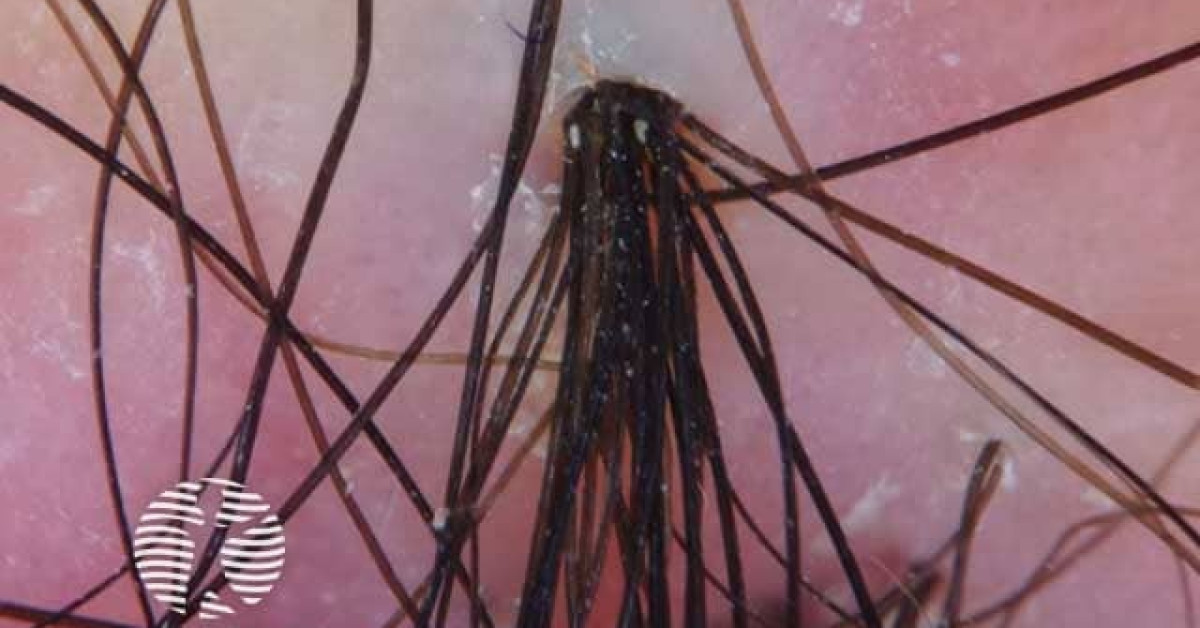 folliculitis-decalvans-image