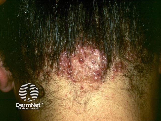 Folliculitis keloidalis nuchae on the nape of the neck