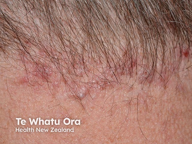 Close-up of the papules on the nape of the neck in folliculitis keloidalis nuchae