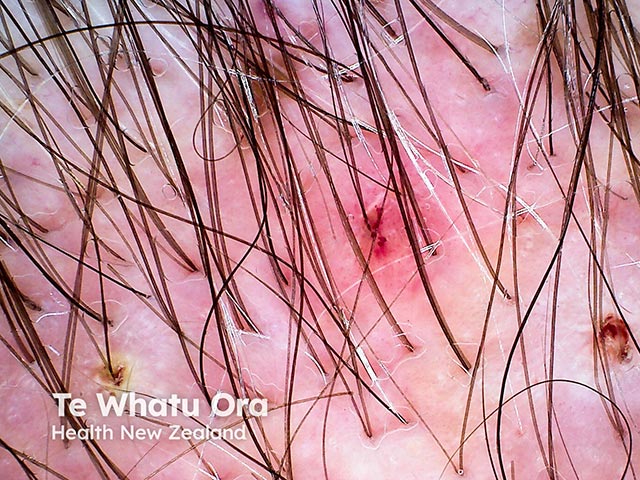 Dermoscopy of mild folliculitis keloidalis  - there is scarring  and hair loss 