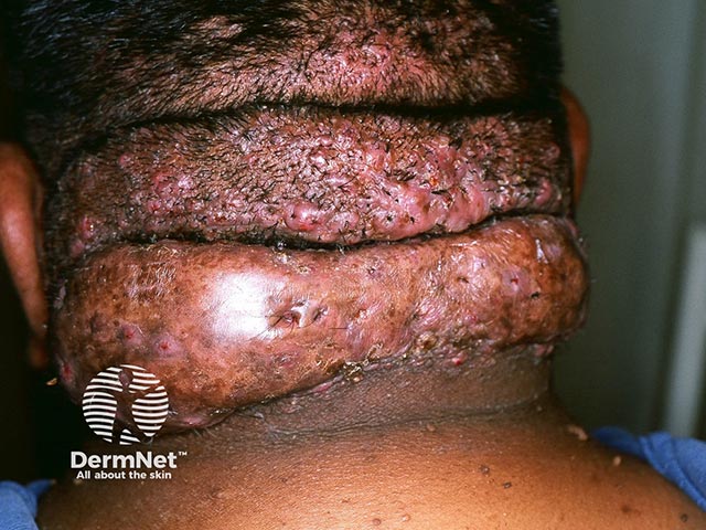 Gross thickening and swelling in advanced folliculitis keloidalis nuchae