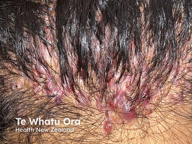 Nape papules and scarring alopecia in moderate folliculitis keloidalis nuchae