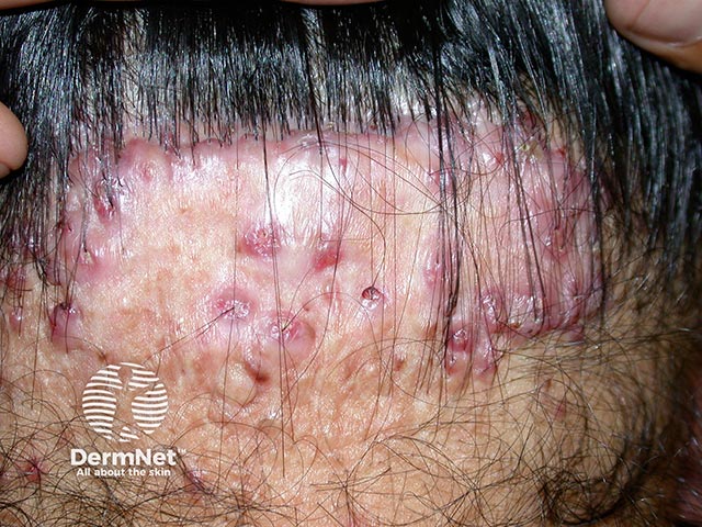 Scarring, nodules and alopecia on the neck due to folliculitis keloidalis nuchae